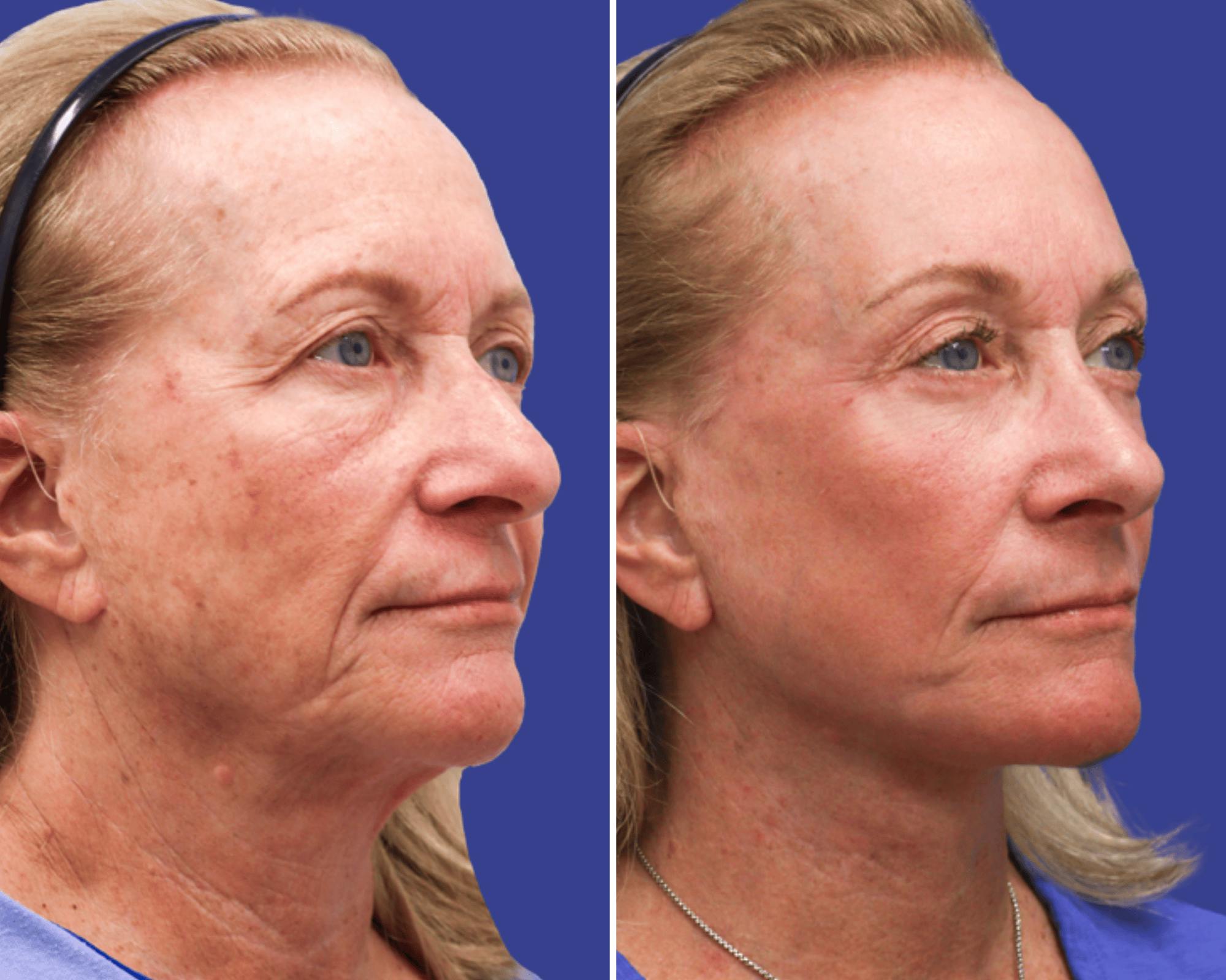 Blepharoplasty Before & After Gallery - Patient 263425 - Image 2