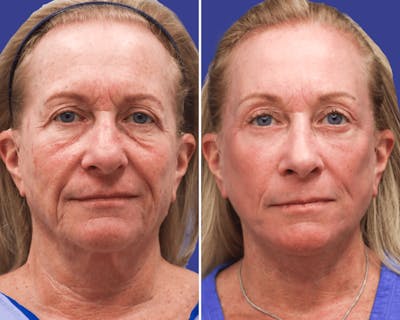 Face Before & After Gallery - Patient 411084 - Image 1