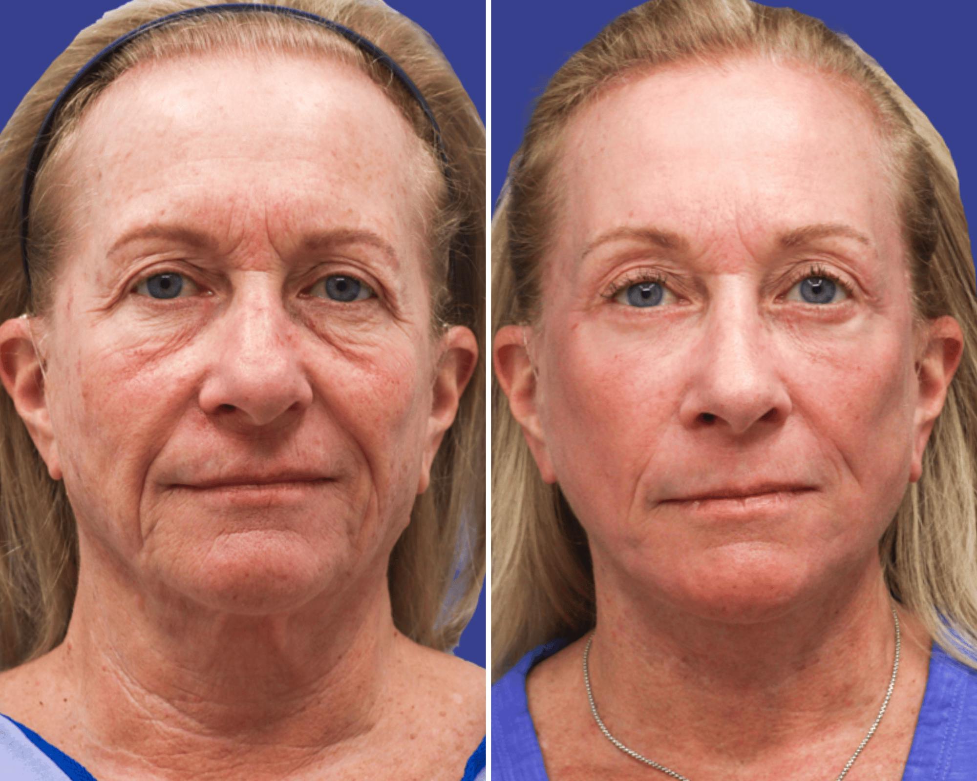 Blepharoplasty Before & After Gallery - Patient 263425 - Image 1