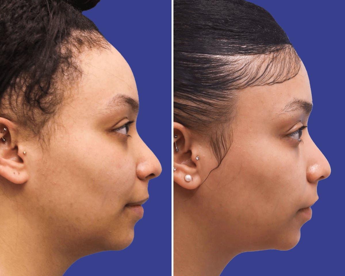 Face Before & After Gallery - Patient 517267 - Image 2