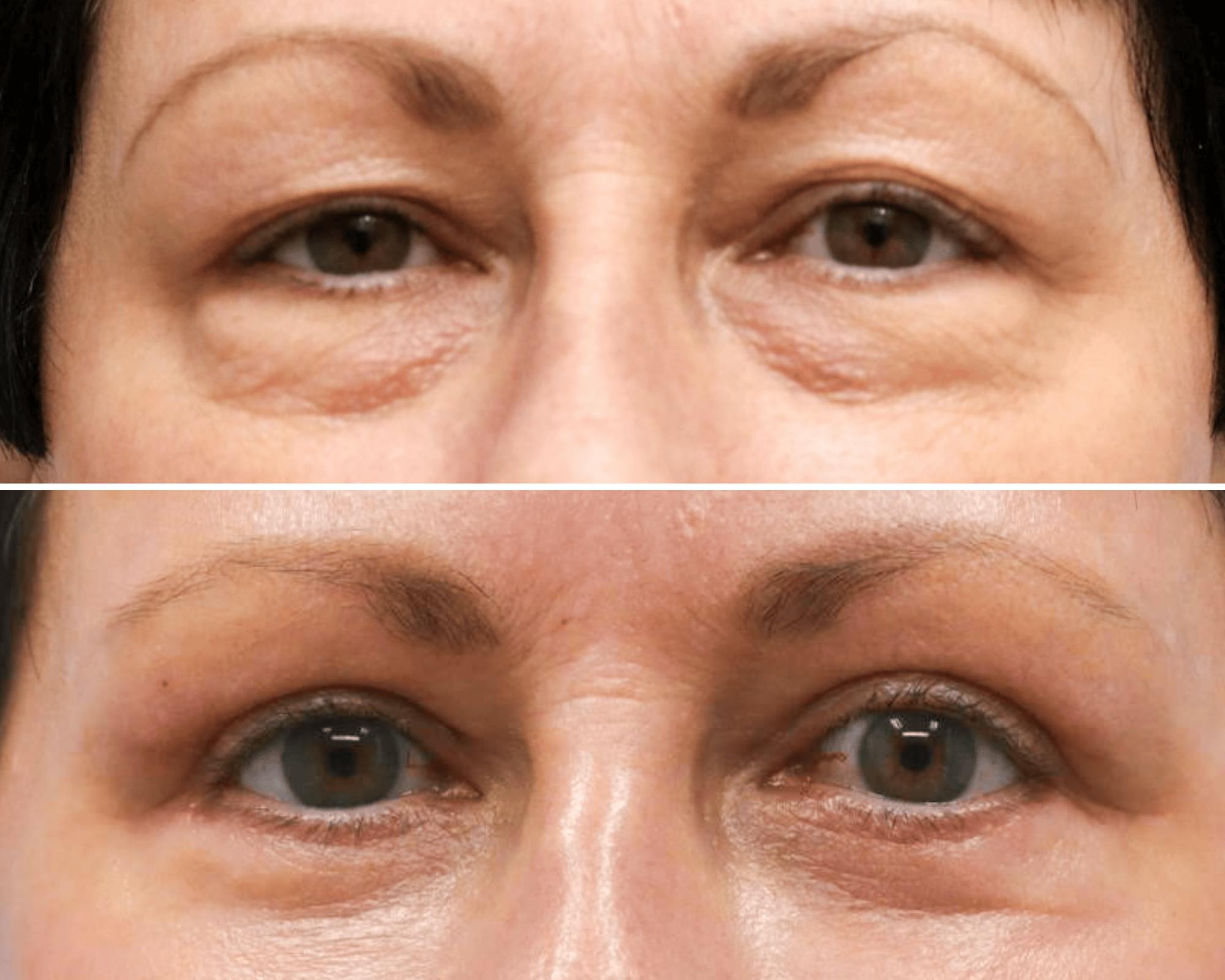 Blepharoplasty Before & After Gallery - Patient 308995 - Image 1
