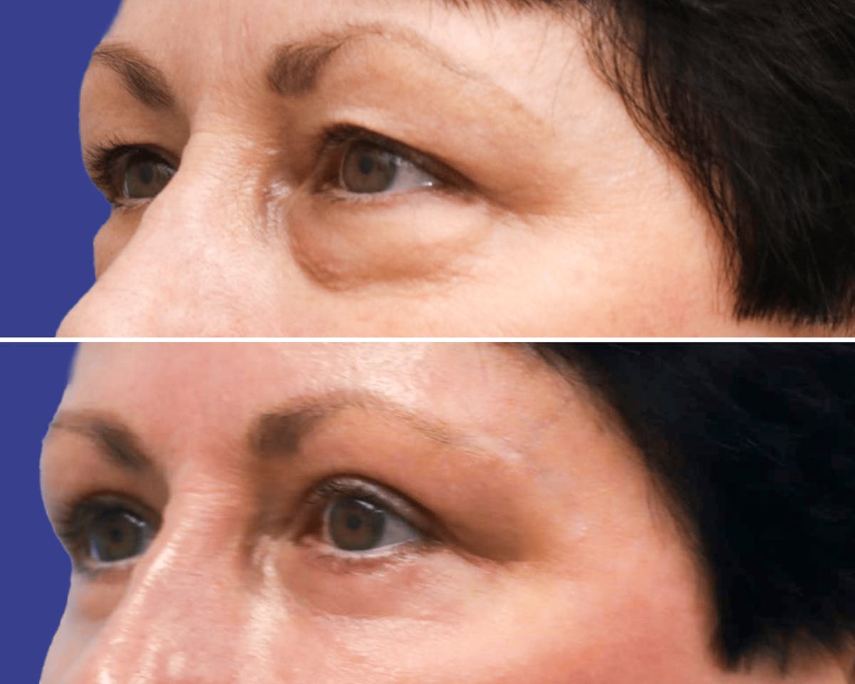 Blepharoplasty Before & After Gallery - Patient 308995 - Image 2