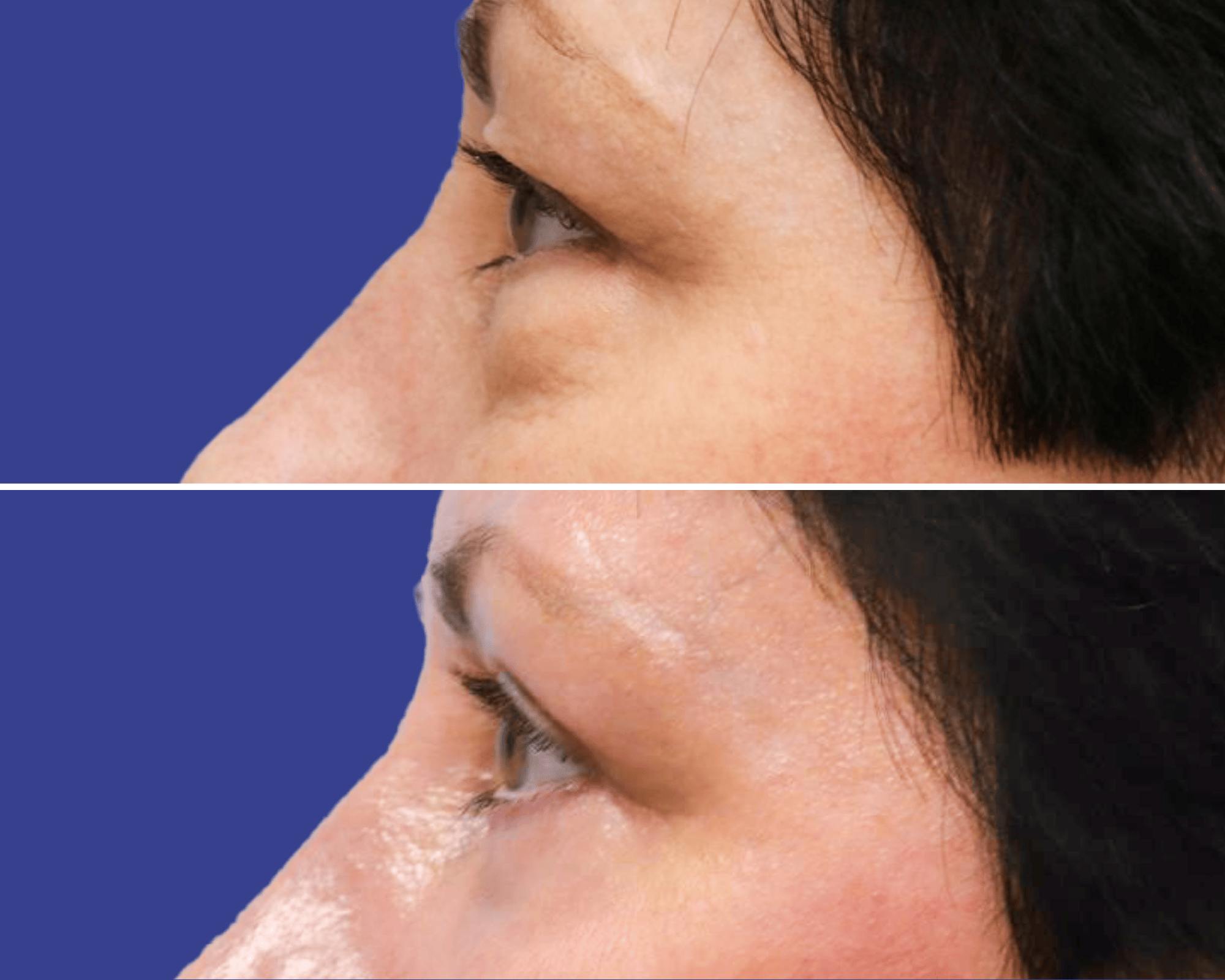 Blepharoplasty Before & After Gallery - Patient 308995 - Image 3