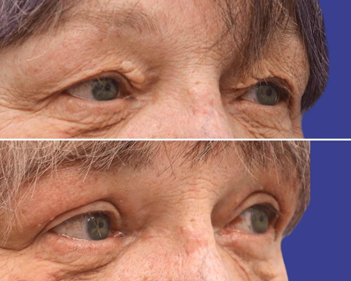 Blepharoplasty Before & After Gallery - Patient 239662 - Image 2