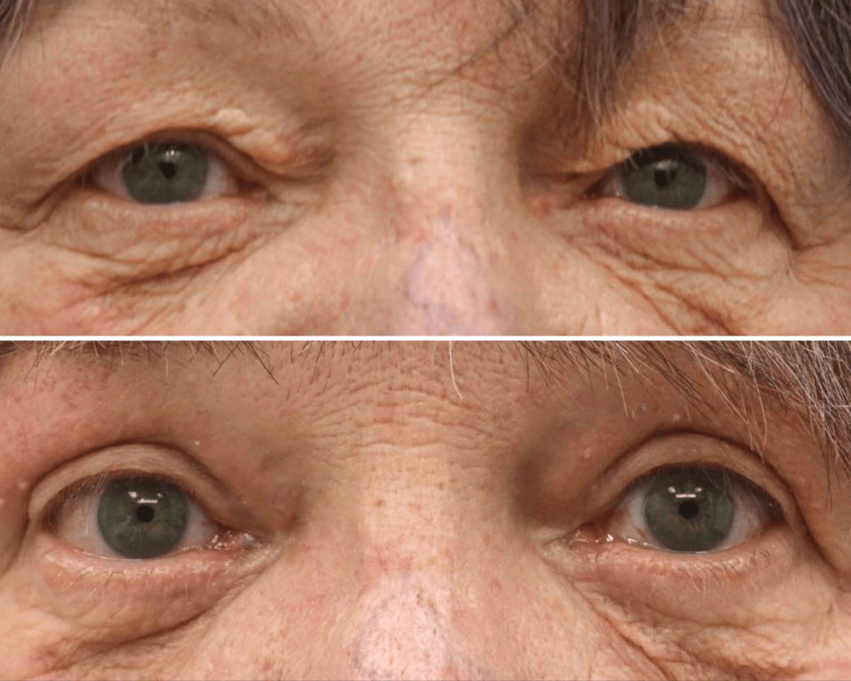 Blepharoplasty Before & After Gallery - Patient 239662 - Image 1