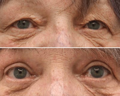 Blepharoplasty Before & After Gallery - Patient 239662 - Image 1