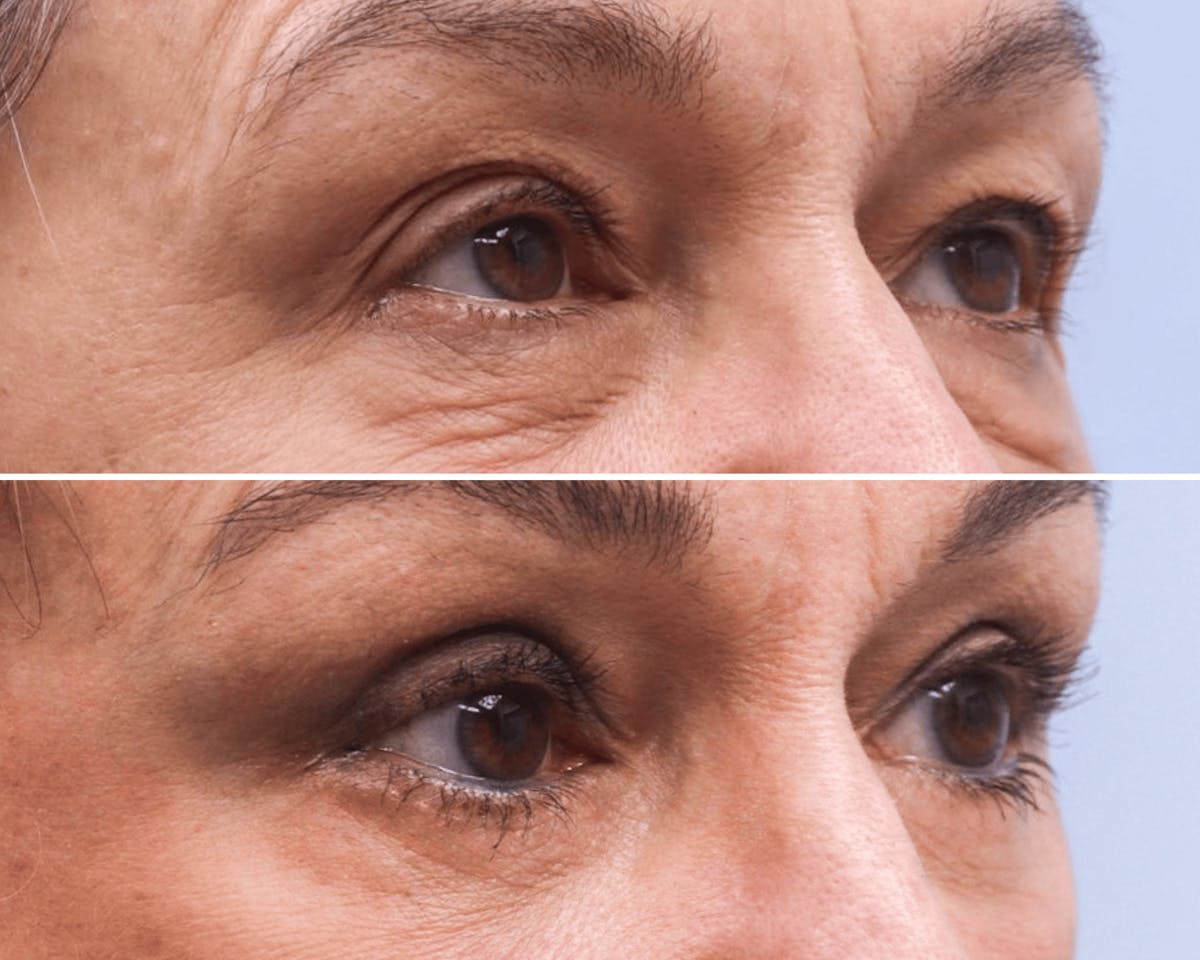 Blepharoplasty Before & After Gallery - Patient 116425 - Image 2