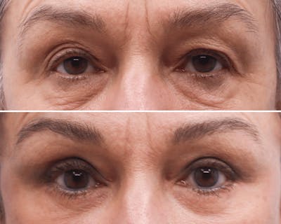 Blepharoplasty Before & After Gallery - Patient 116425 - Image 1