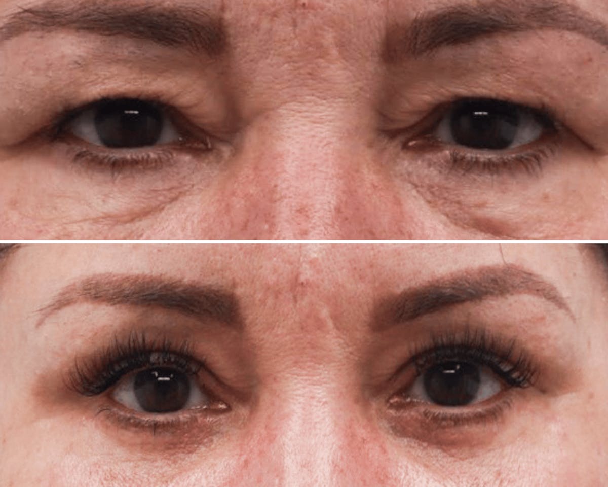 Blepharoplasty Before & After Gallery - Patient 253229 - Image 1
