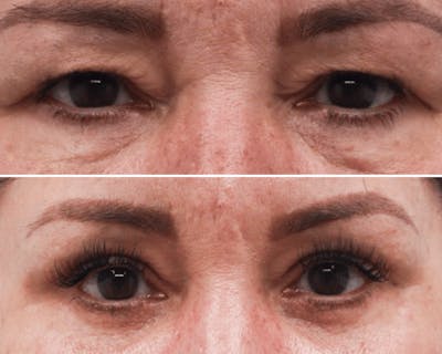 Blepharoplasty Before & After Gallery - Patient 253229 - Image 1