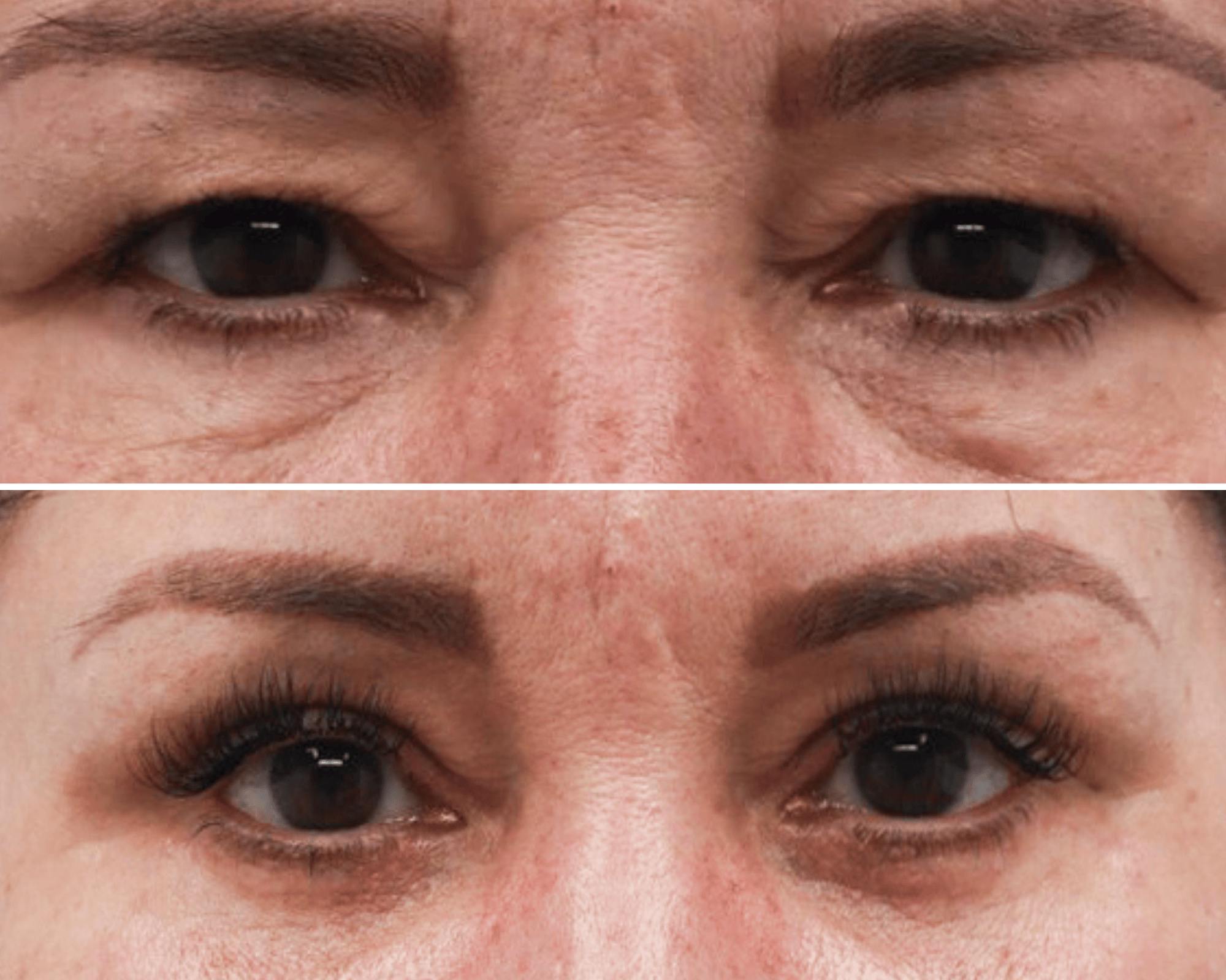 Temple Lift Before & After Gallery - Patient 339632 - Image 1