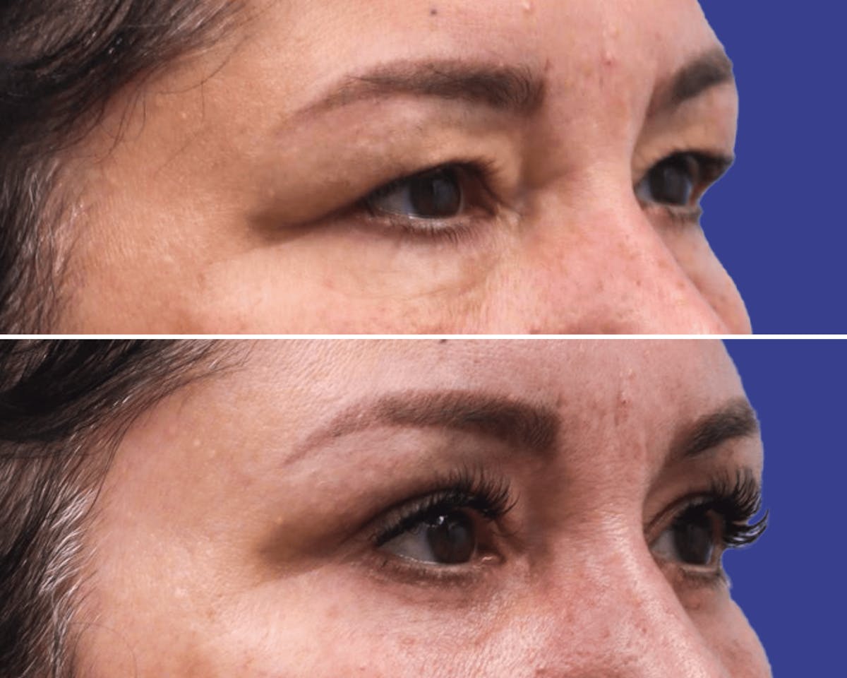 Blepharoplasty Before & After Gallery - Patient 253229 - Image 2