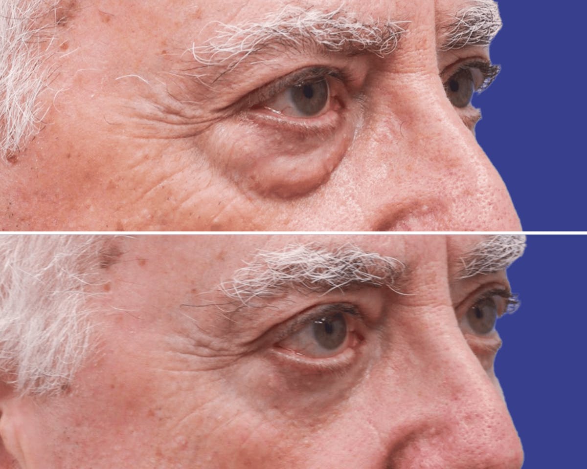 Blepharoplasty Before & After Gallery - Patient 153079 - Image 2