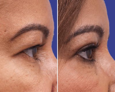 Blepharoplasty Before & After Gallery - Patient 275821 - Image 1