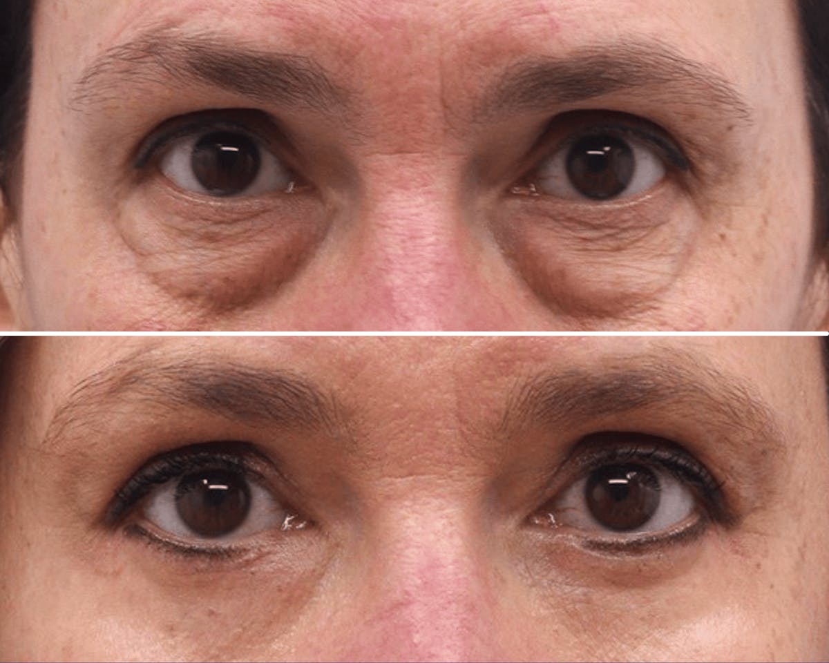 Blepharoplasty Before & After Gallery - Patient 601608 - Image 1