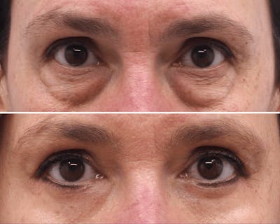 Blepharoplasty Before & After Gallery - Patient 601608 - Image 1