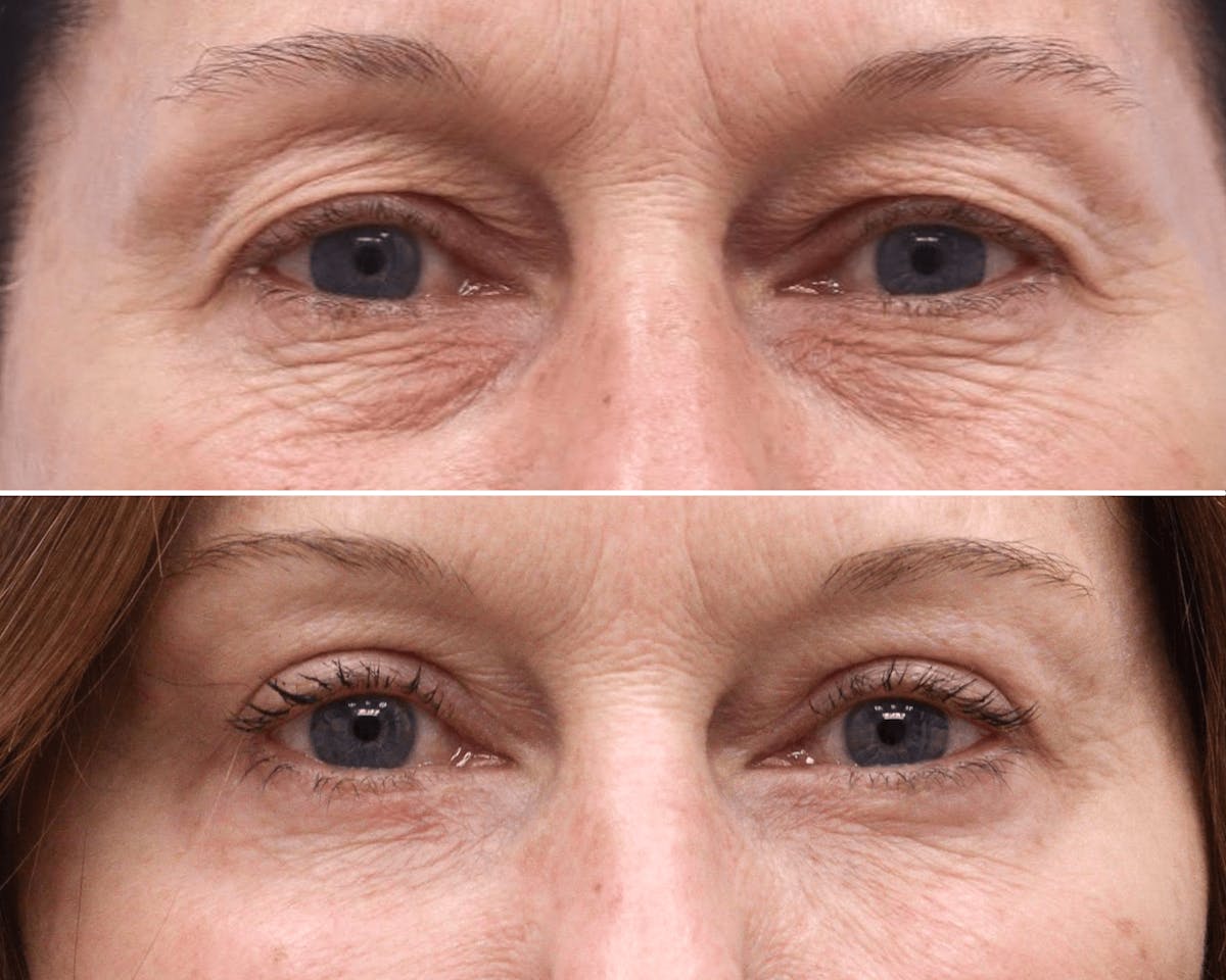 Blepharoplasty Before & After Gallery - Patient 388085 - Image 1