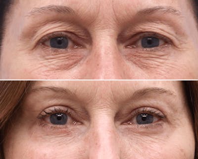 Blepharoplasty Before & After Gallery - Patient 388085 - Image 1