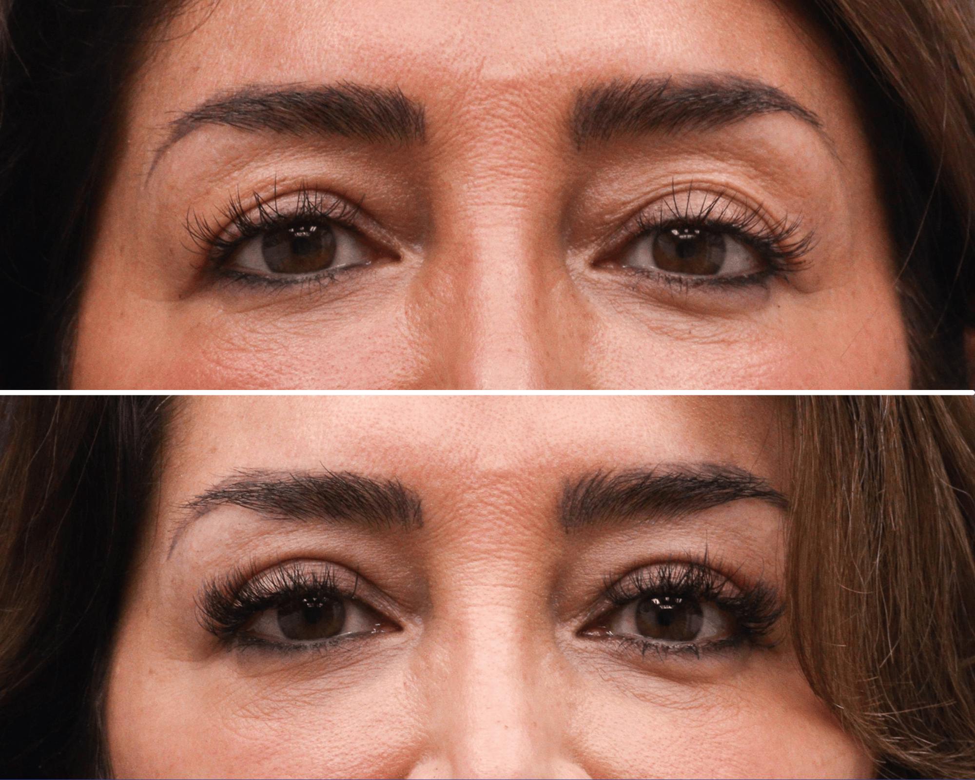 Blepharoplasty Before & After Gallery - Patient 339821 - Image 1
