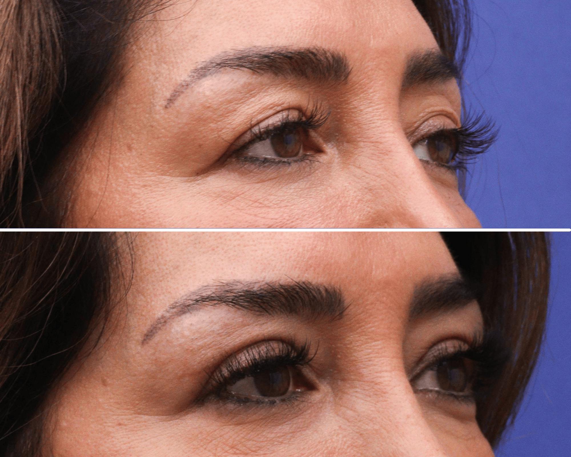 Blepharoplasty Before & After Gallery - Patient 339821 - Image 2