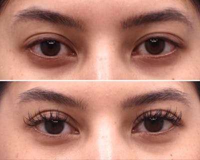 Blepharoplasty Before & After Gallery - Patient 859052 - Image 1