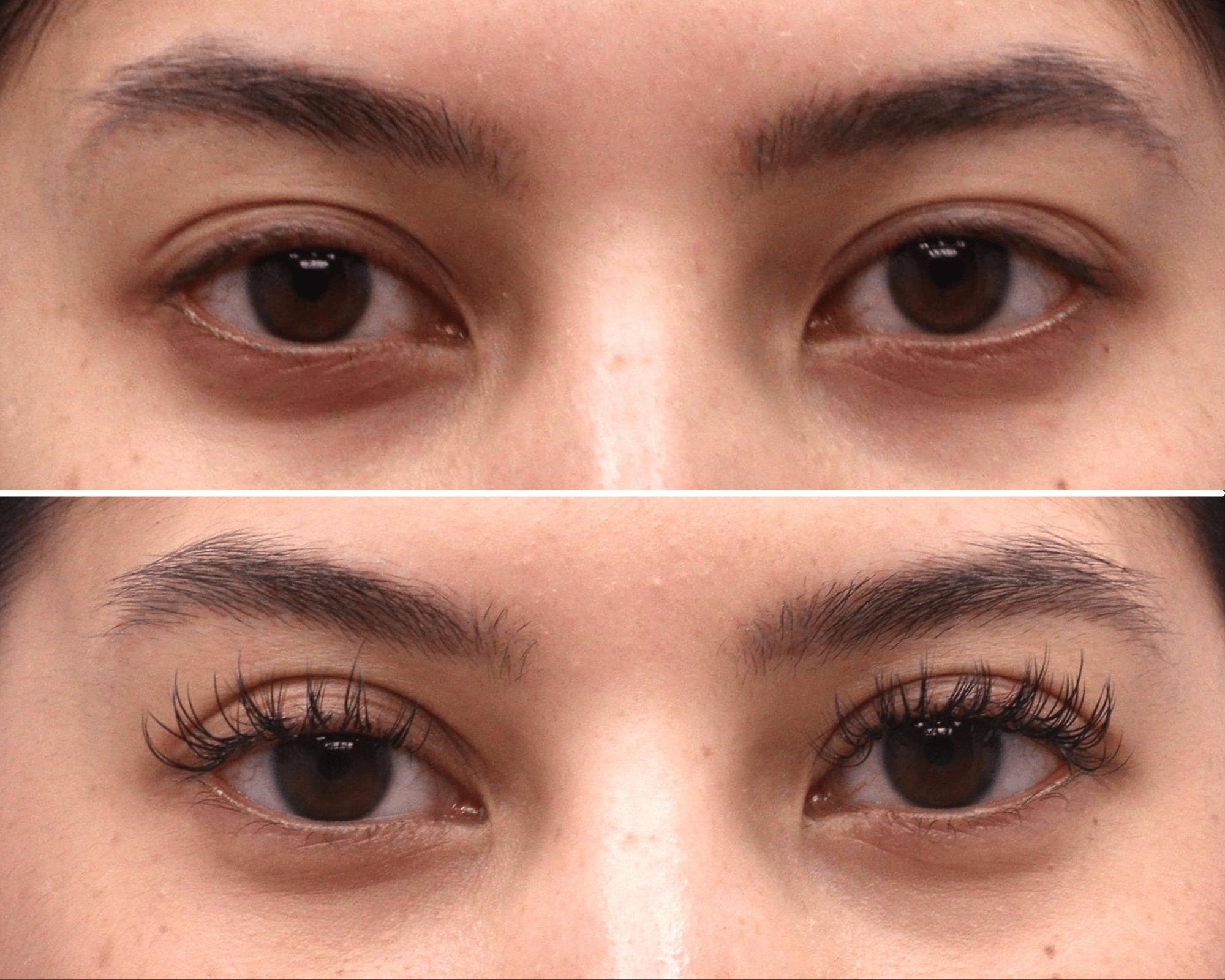 Blepharoplasty Before & After Gallery - Patient 859052 - Image 1