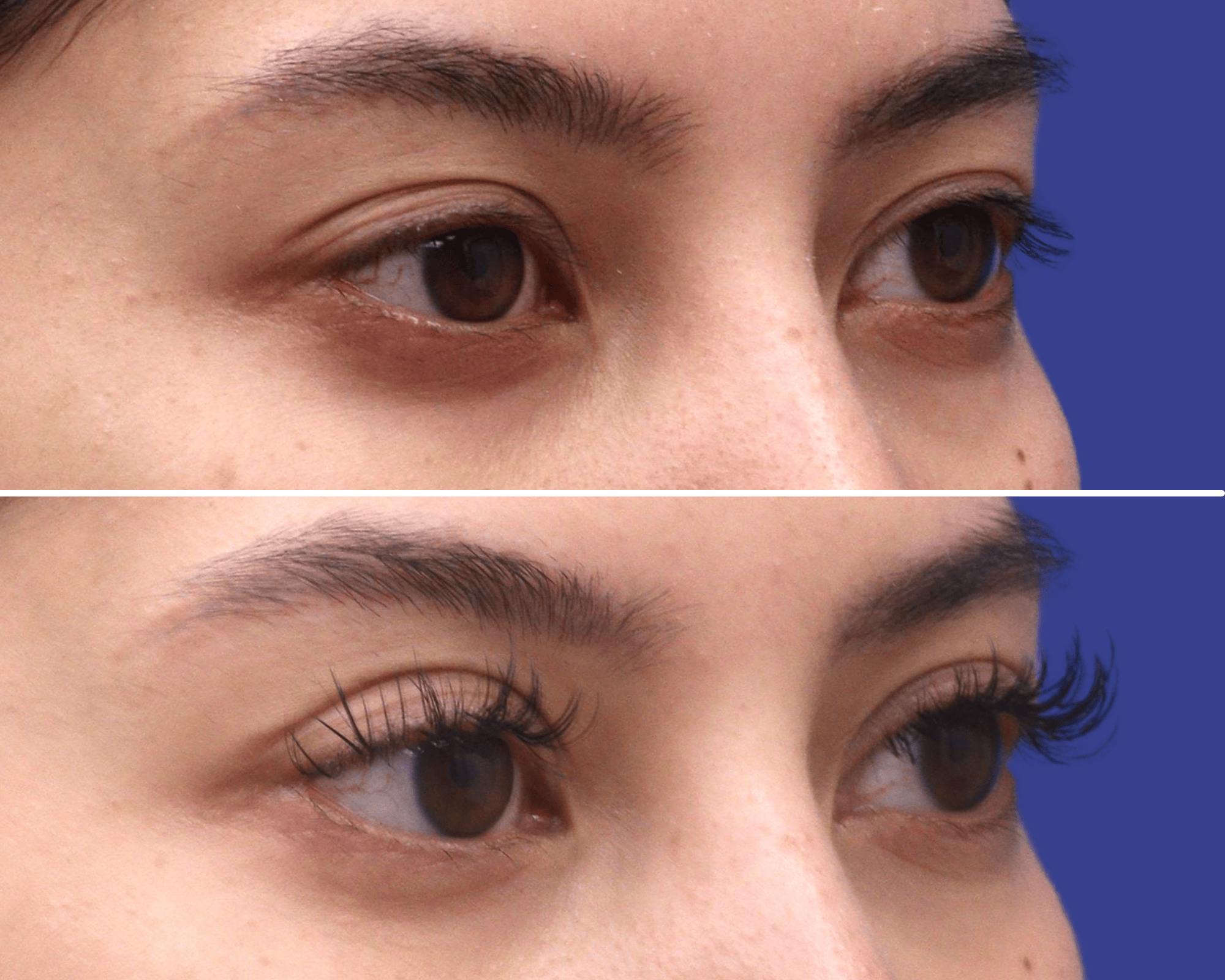 Blepharoplasty Before & After Gallery - Patient 859052 - Image 2