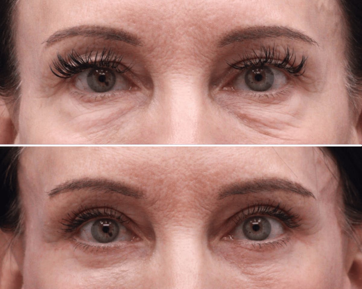 Blepharoplasty Before & After Gallery - Patient 278363 - Image 1