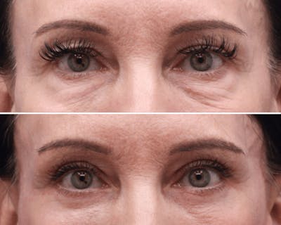 Blepharoplasty Before & After Gallery - Patient 278363 - Image 1