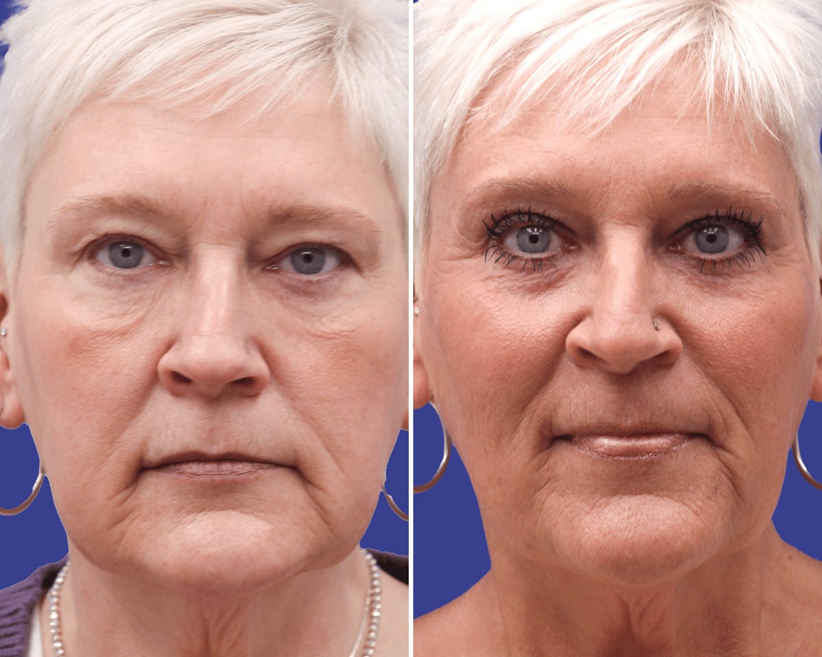 Blepharoplasty Before & After Gallery - Patient 490242 - Image 1