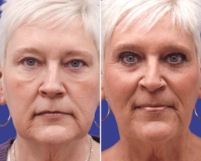 Blepharoplasty Before & After Gallery - Patient 490242 - Image 1
