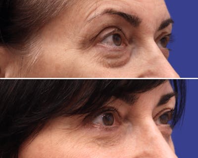 Blepharoplasty Before & After Gallery - Patient 829715 - Image 1