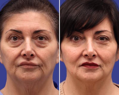 Blepharoplasty Before & After Gallery - Patient 204350 - Image 1