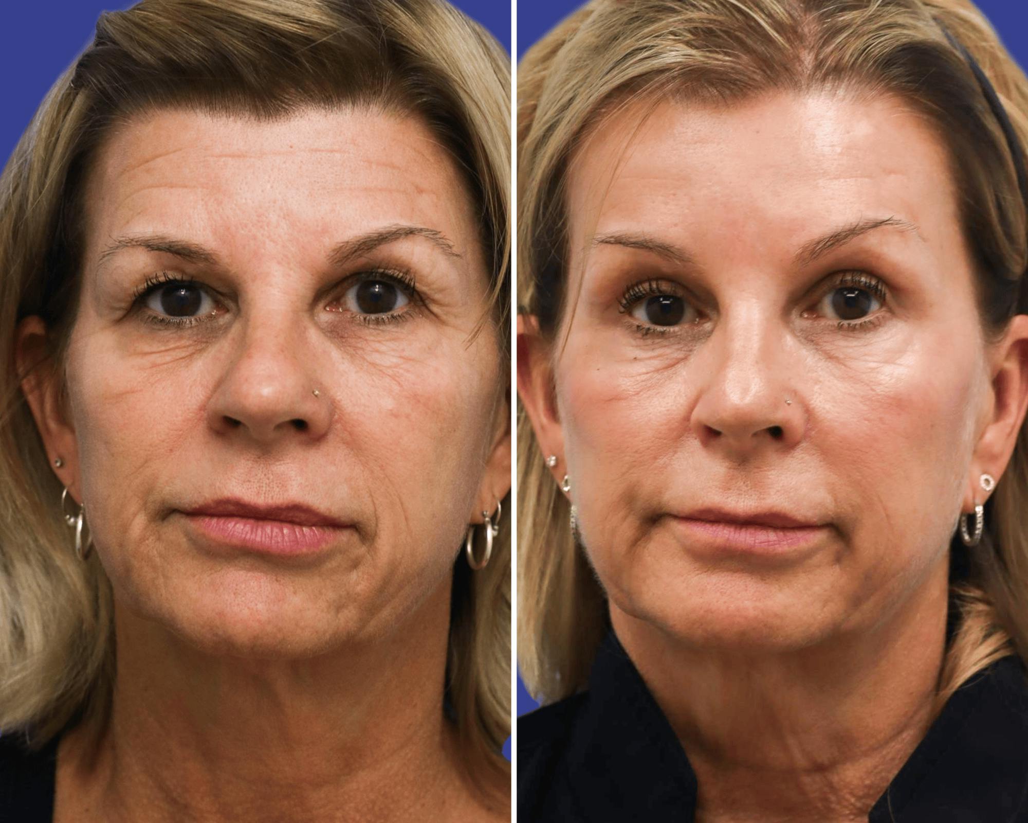 Brow Lift Before & After Gallery - Patient 165606 - Image 1
