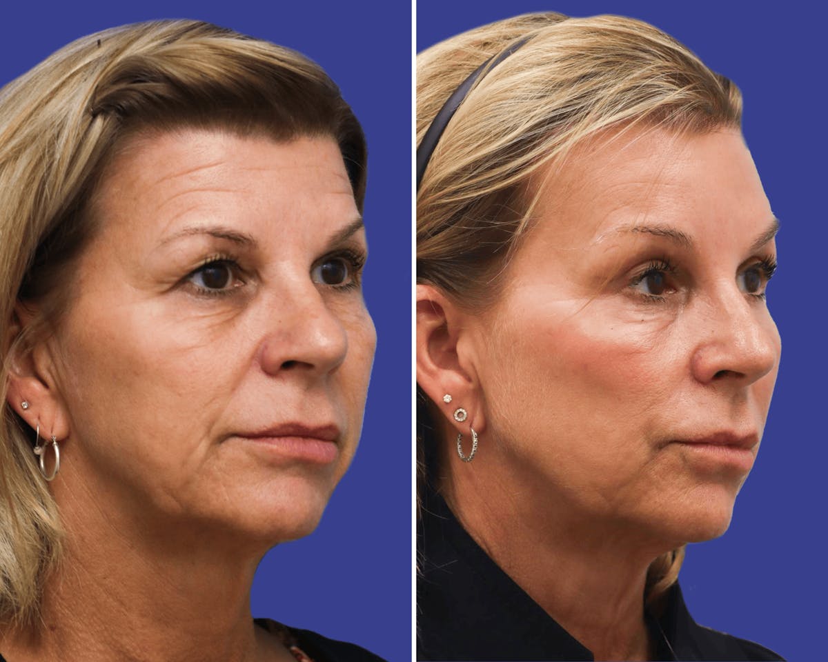 Brow Lift Before & After Gallery - Patient 165606 - Image 2