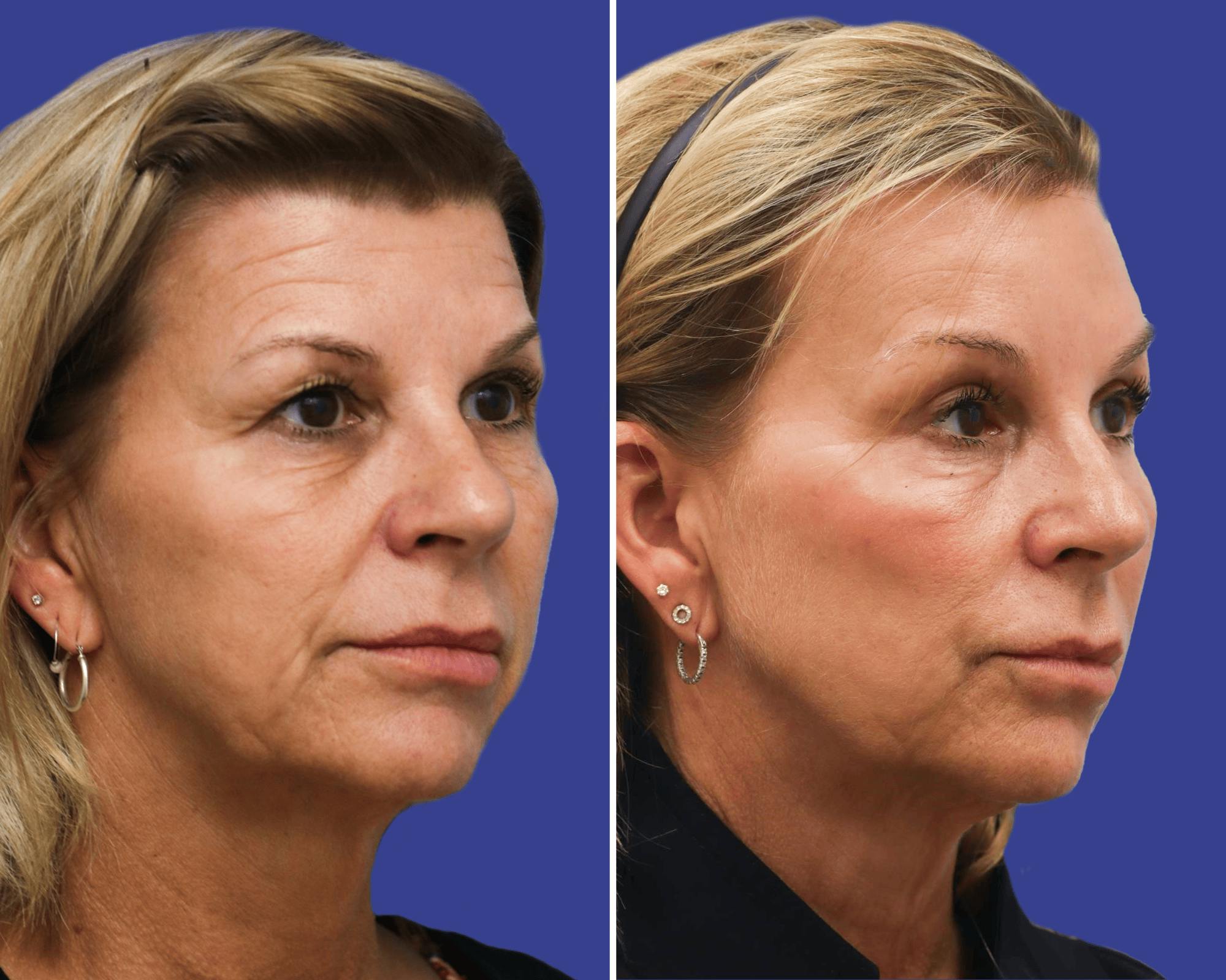 Brow Lift Before & After Gallery - Patient 165606 - Image 2