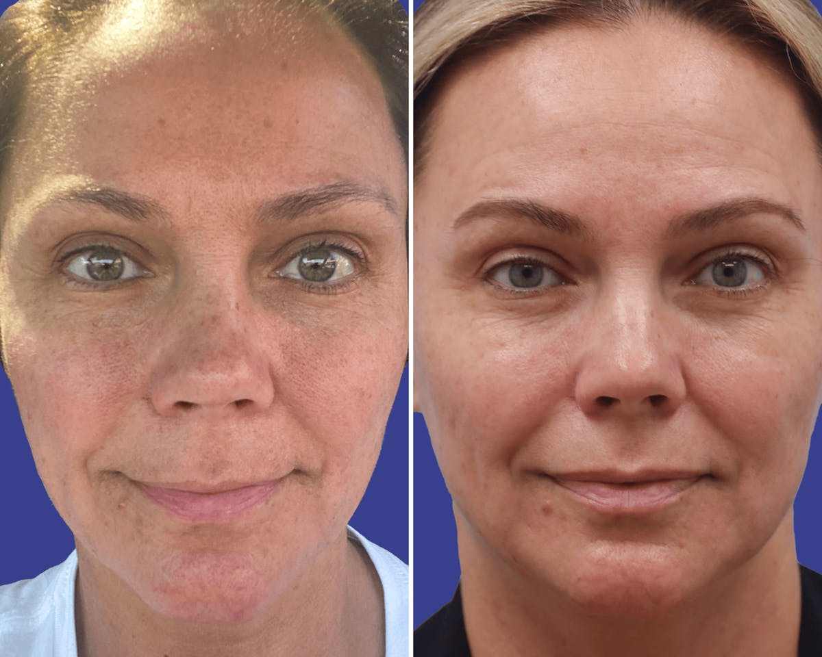 Lips Before & After Gallery - Patient 271918 - Image 1