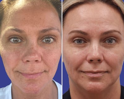 Lips Before & After Gallery - Patient 271918 - Image 1