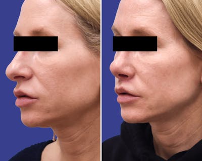 Lip Lift Before & After Gallery - Patient 106297 - Image 1