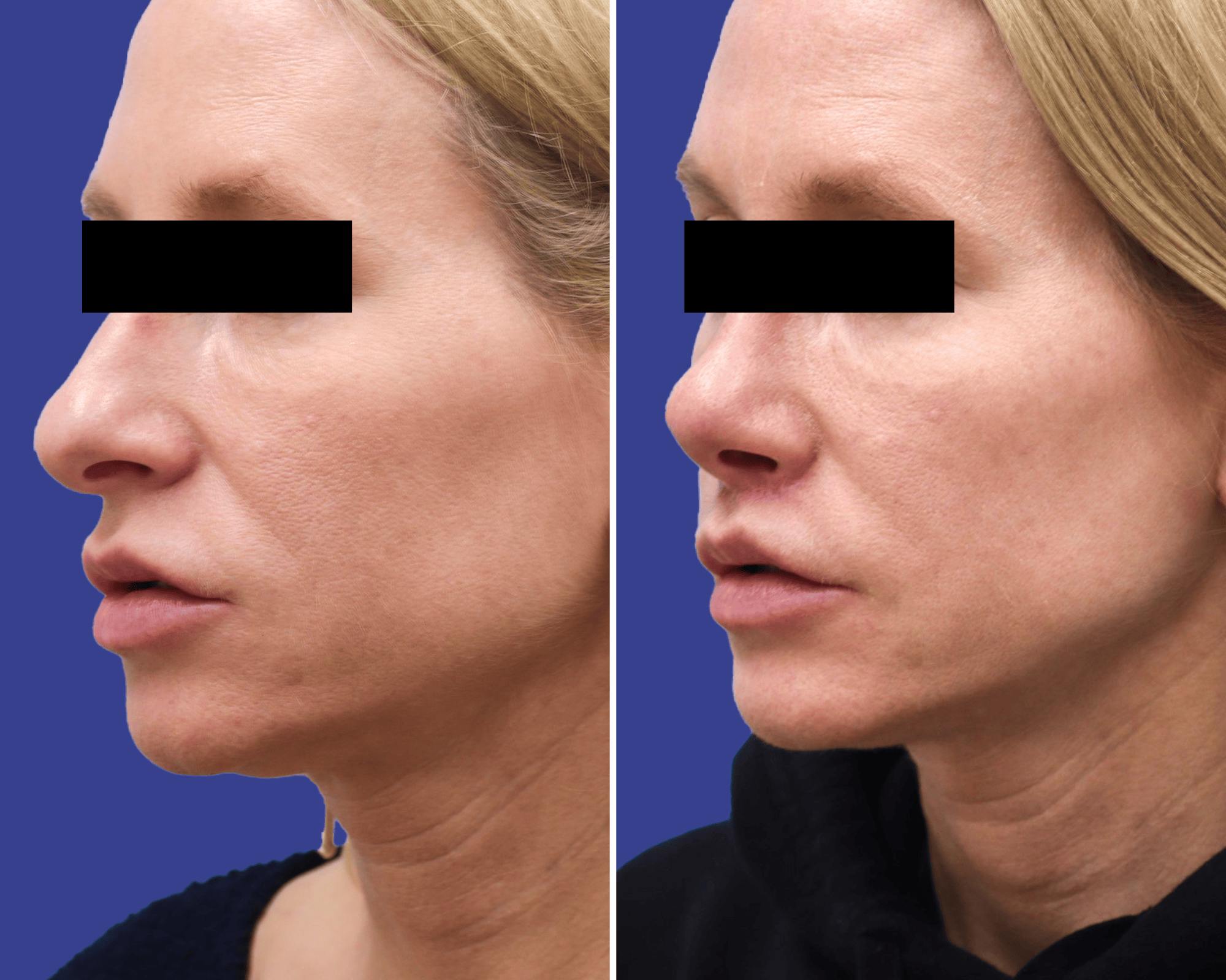 Lip Lift Before & After Gallery - Patient 106297 - Image 1
