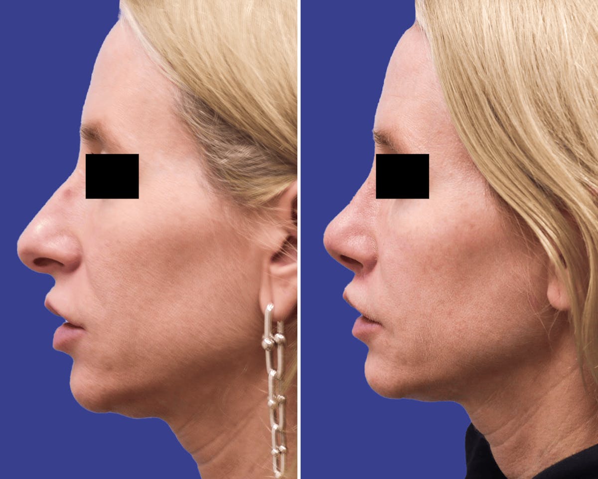 Lip Lift Before & After Gallery - Patient 106297 - Image 2