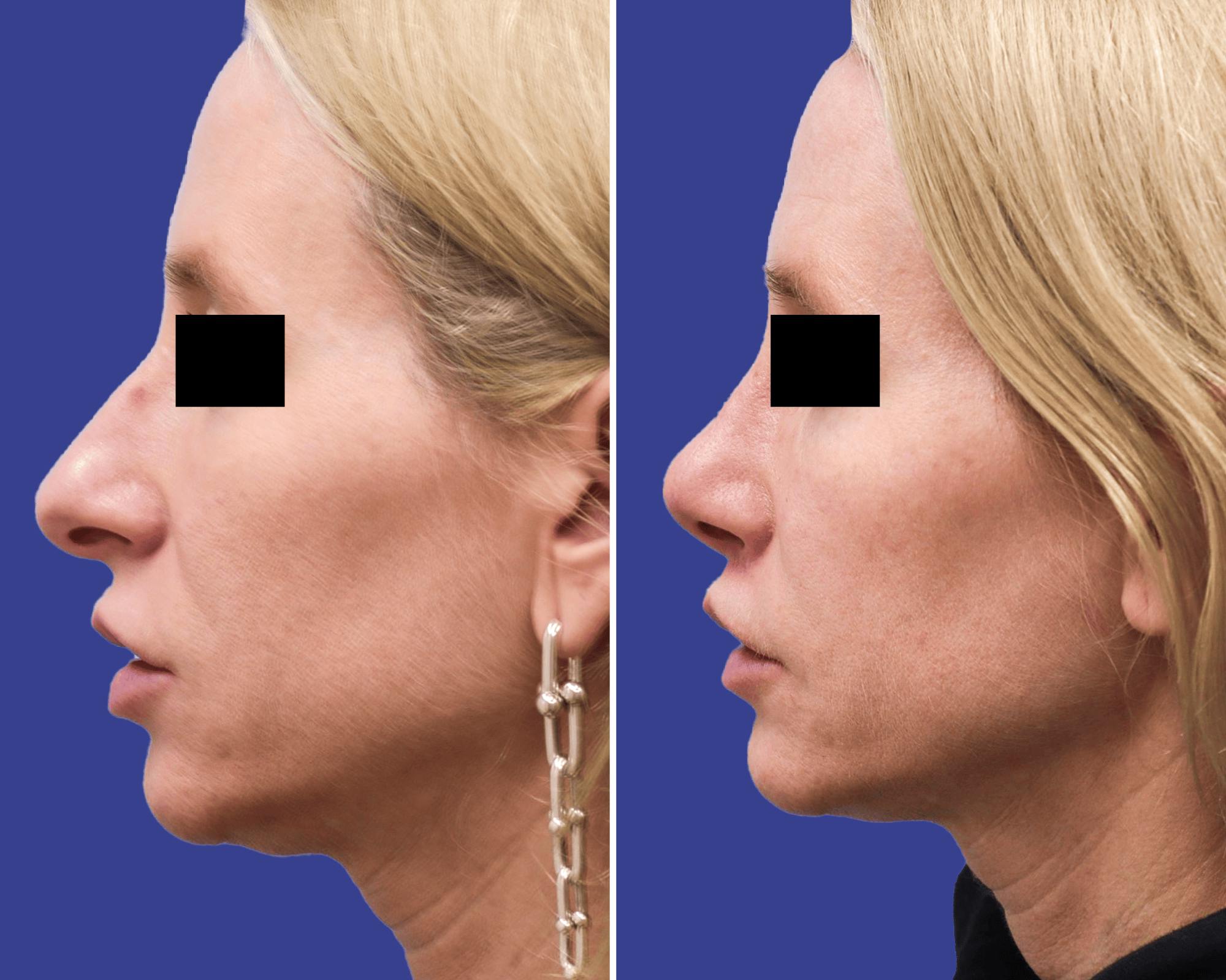 Lip Lift Before & After Gallery - Patient 106297 - Image 2