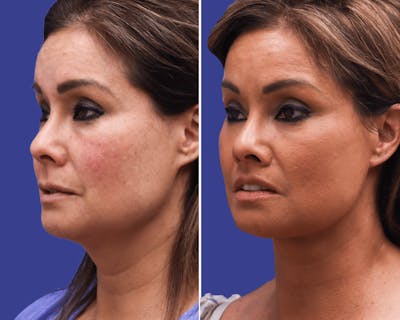 Lips Before & After Gallery - Patient 116628 - Image 1