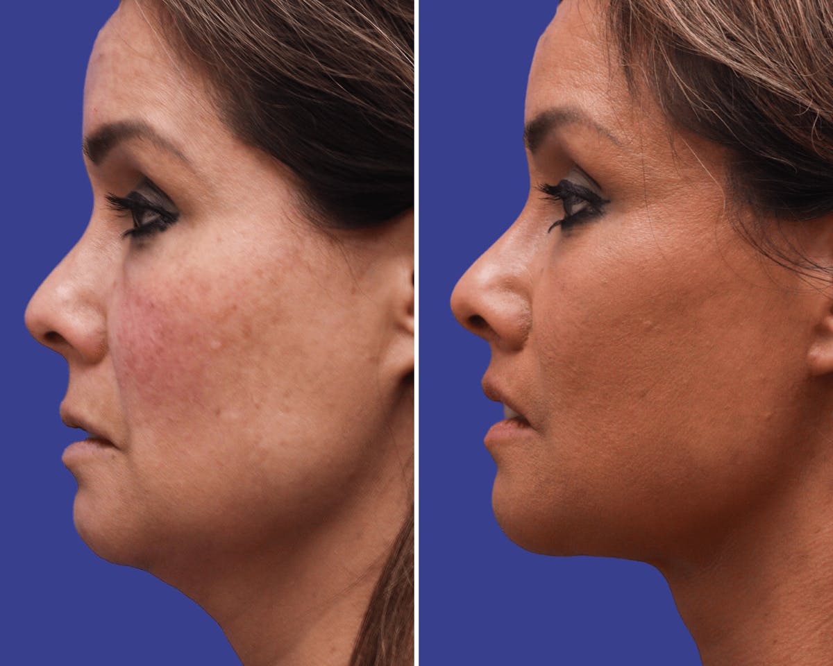Lips Before & After Gallery - Patient 116628 - Image 2