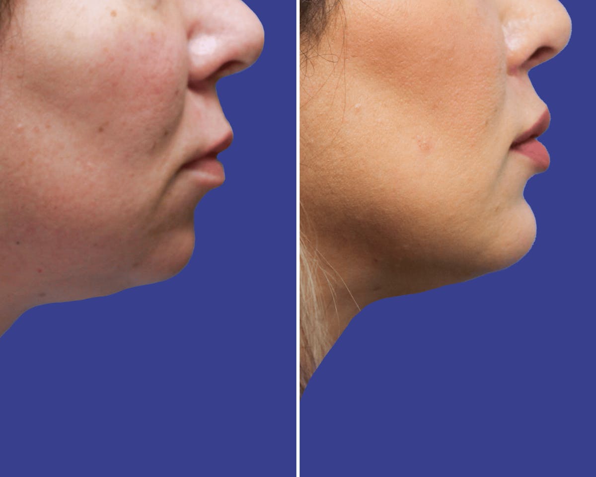 Lips Before & After Gallery - Patient 387002 - Image 3