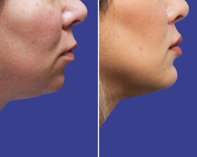 Chin Implants Before & After Gallery - Patient 230113 - Image 1