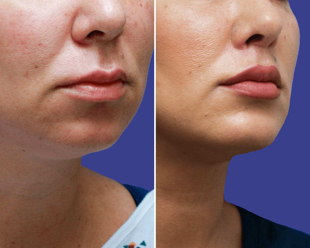 Lips Before & After Gallery - Patient 387002 - Image 2