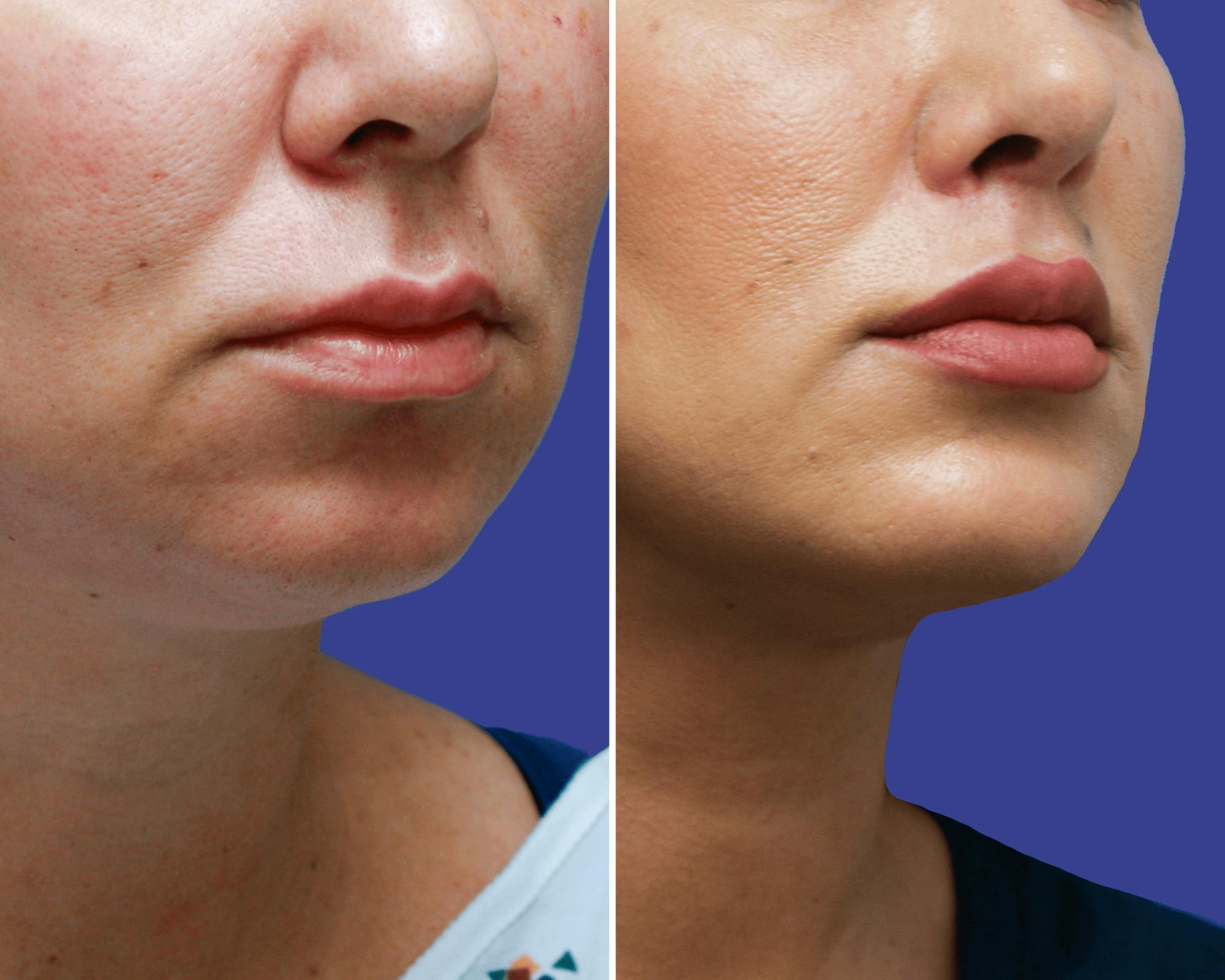 Chin Implants Before & After Gallery - Patient 230113 - Image 2