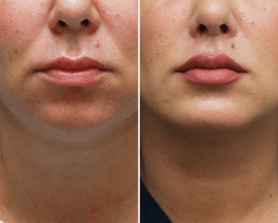 Lips Before & After Gallery - Patient 387002 - Image 1