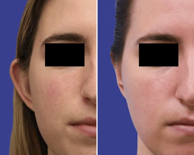 Otoplasty Before & After Gallery - Patient 409463 - Image 1